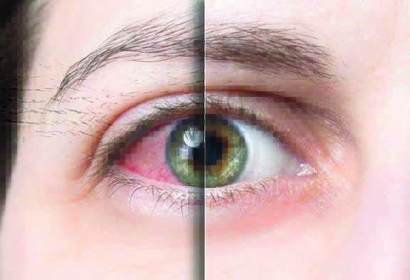 महिलांमधील मधुमेह  आणि डोळ्यांचे आरोग्य:  रेटीनोपॅथीचे धोके आणि उपाय