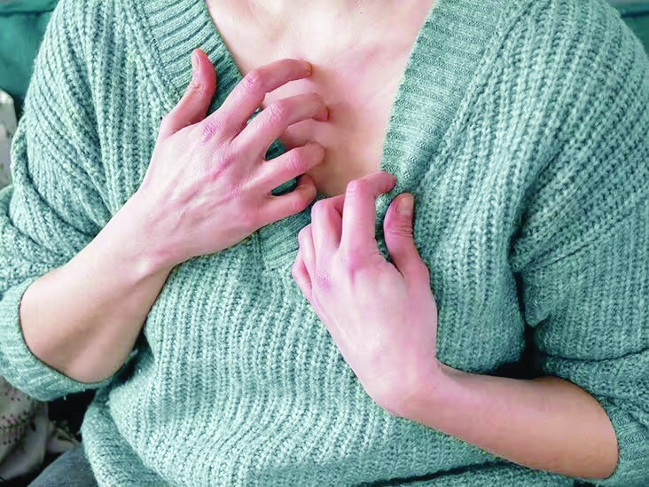 पीसीओएसमुळे महिलांमध्ये अॅलर्जी कशी वाढते?