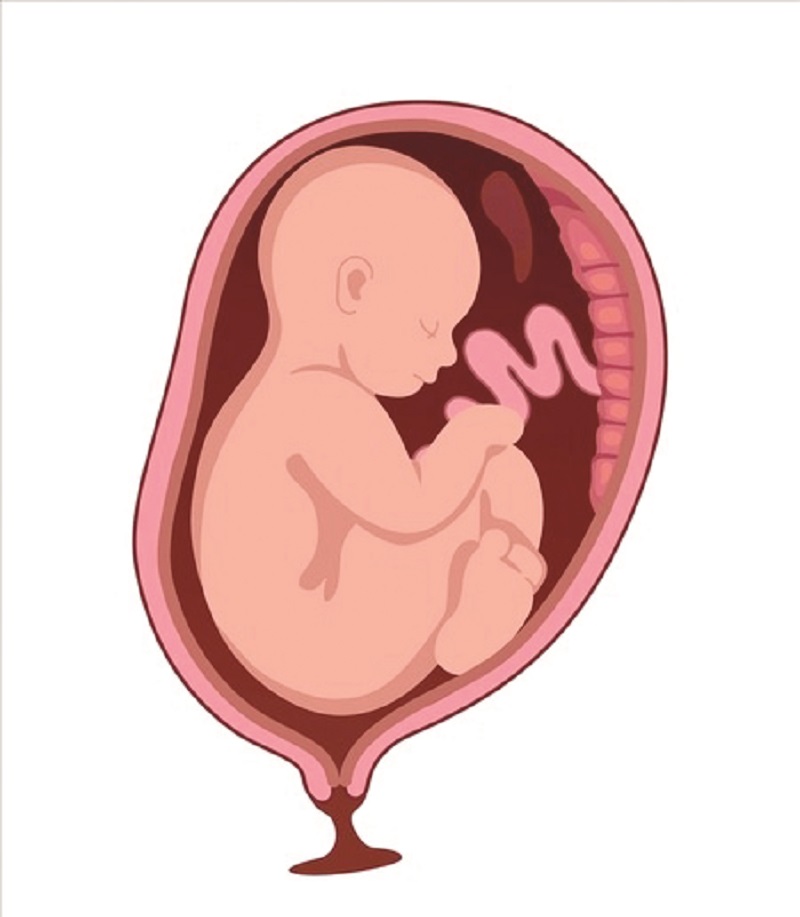 ब्रीच प्रेझेंटेशनसाठी सिझेरियनच का?